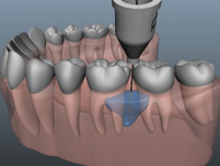 Centre dentaire Lancy - Anesthésie