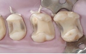 caries dentaires