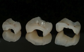 caries dentales