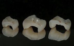 dental cavities