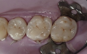 caries dentaires