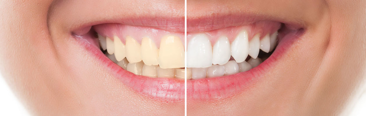 Centre dentaire Chêne-Bourg - Dental whitening