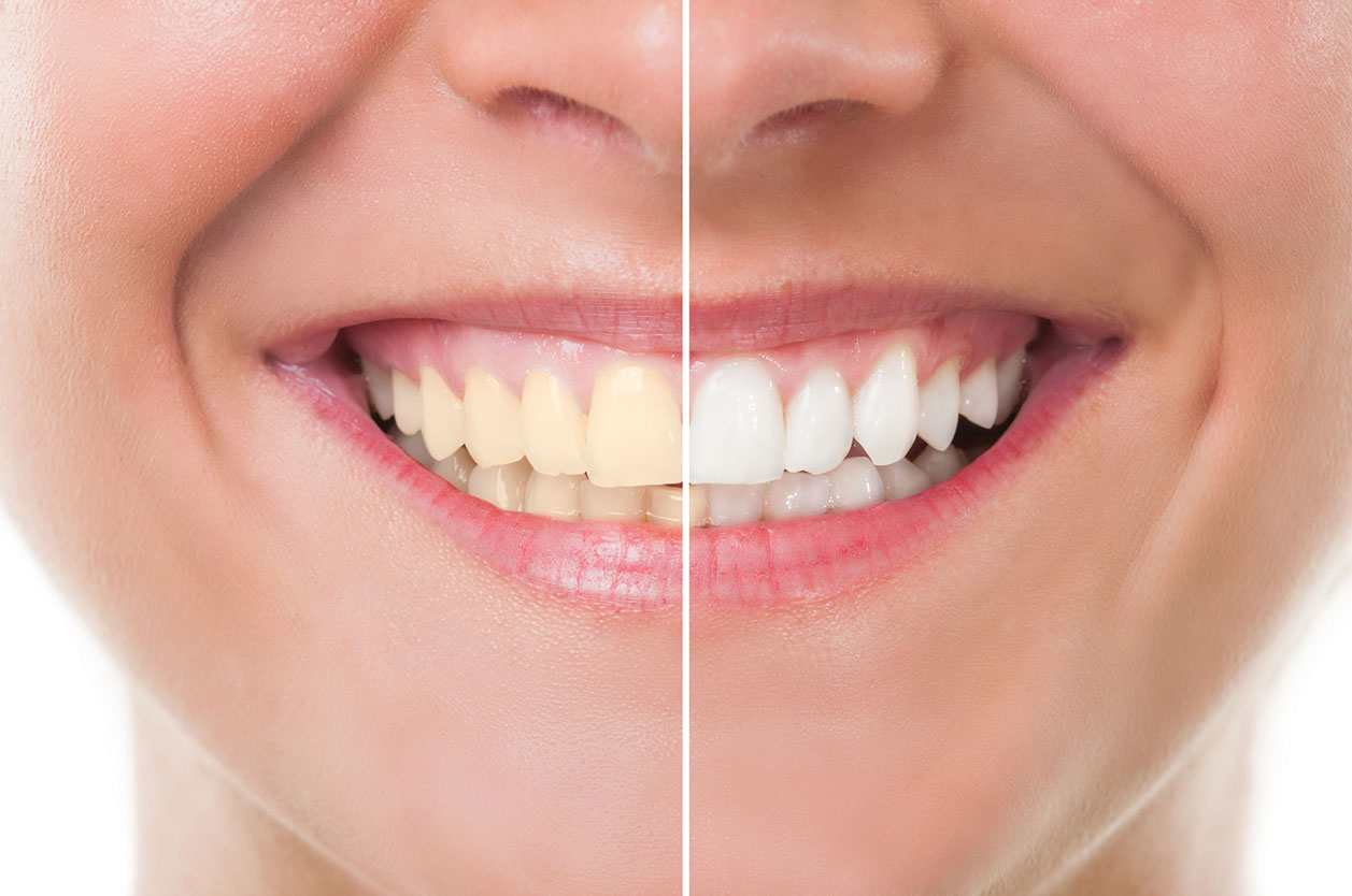 Centre dentaire Chêne-Bourg - Dental whitening