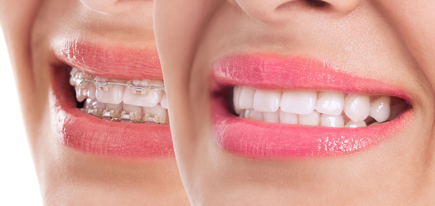 Lancy Dental Centre - Ortodontia para adultos