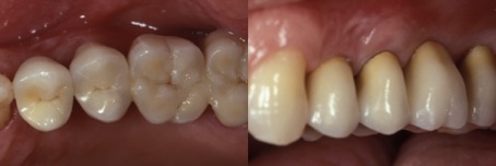 reconstrução dentária