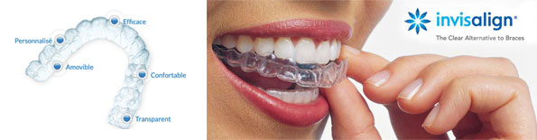 Centre dentaire Lancy - Invisalign