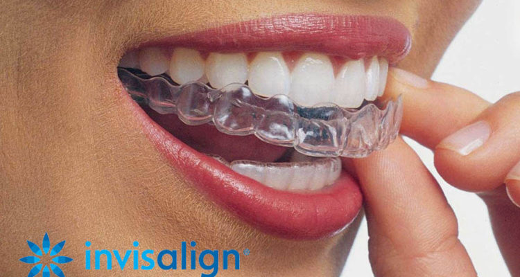 Invisalign® Centre Dentaire Chêne-Bourg