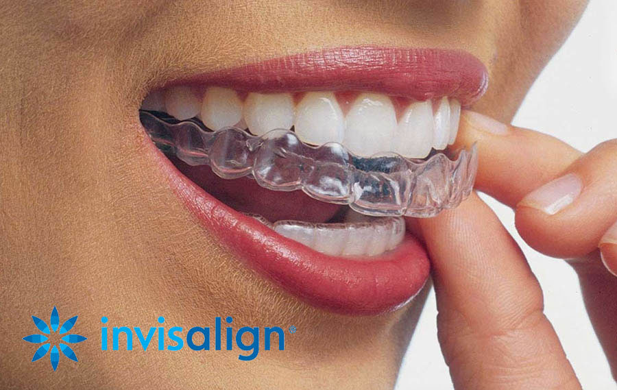 Invisalign®-Zentrum Dentaire Chêne-Bourg