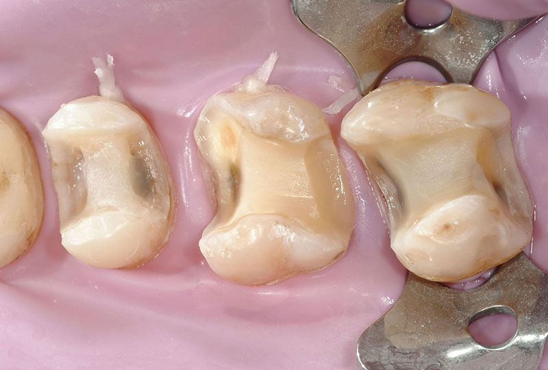 centro dental onlay