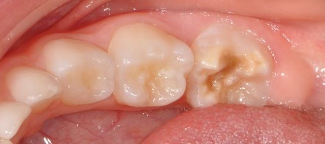 children's teeth stains