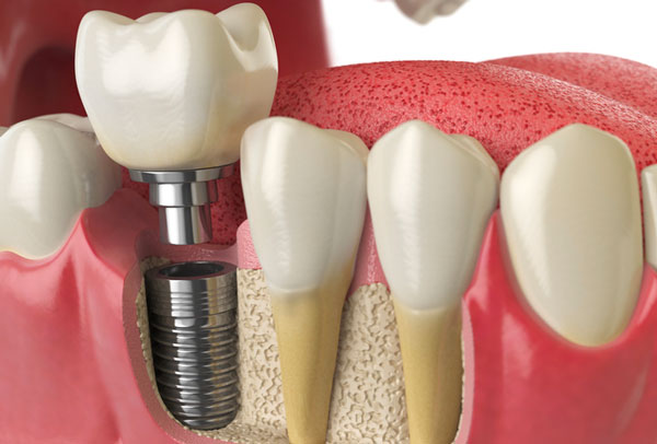 burg channel implant surgery