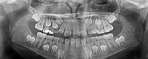 Radiografia panorâmica para crianças