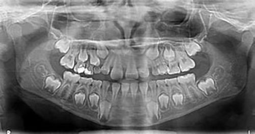 Radiografía panorámica para niños