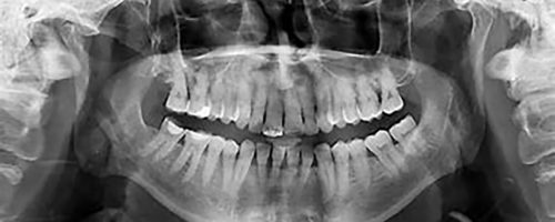 Radiographie Panoramique Adulte