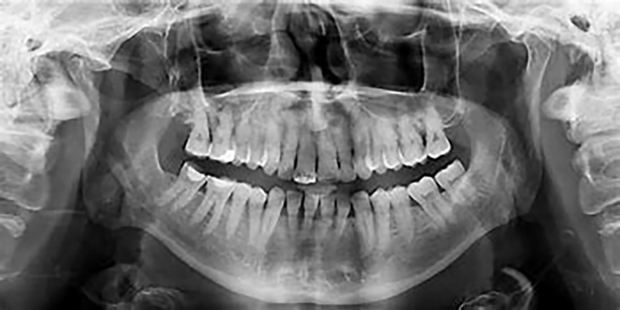 Radiographie Panoramique Adulte