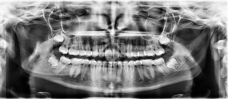 Radiografía panorámica para niños