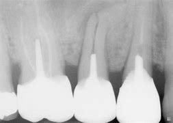 Radiographie Periapicale