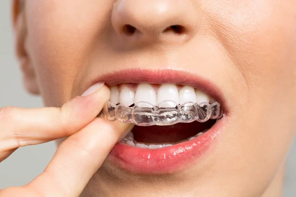 orthodontie adulte