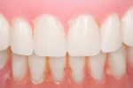 traiter la décoloration des dents