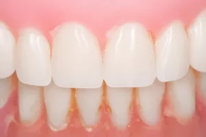 traiter la décoloration des dents