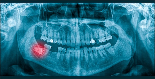 Wisdom teeth