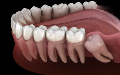 How can I soothe the pain of wisdom teeth?