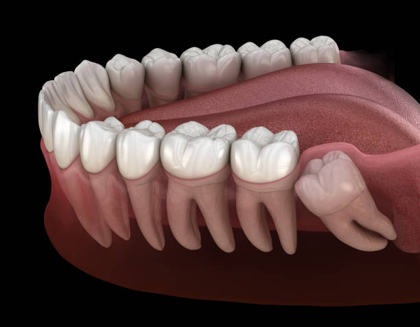 extração do dente do siso