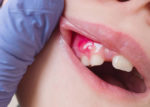 Abcesso dentário
