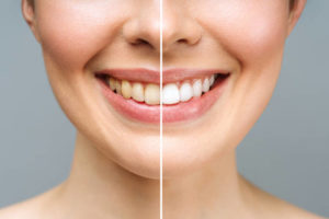 Dental bleaching geneva