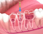 endodontie