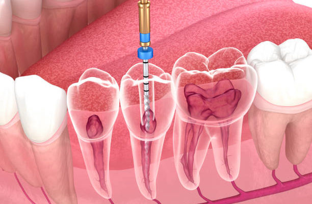 endodontie