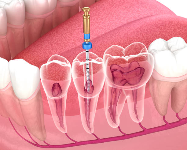 endodontie
