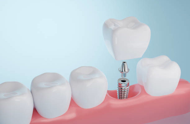 dental implant