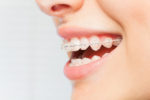 transparent braces