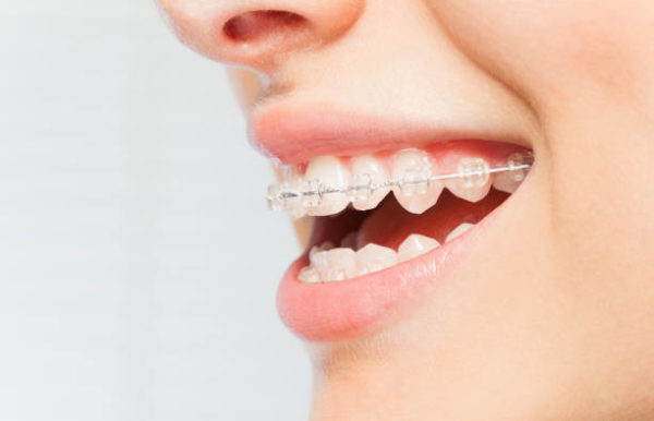 appareil dentaire transparent appareil dentaire transparent