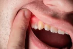 Zahnfleischabzesse